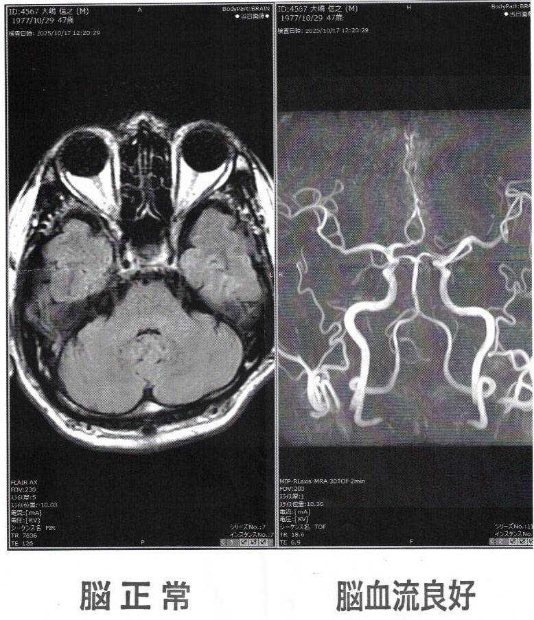 脳のMRI、MRA検査画像(2025年10月17日)