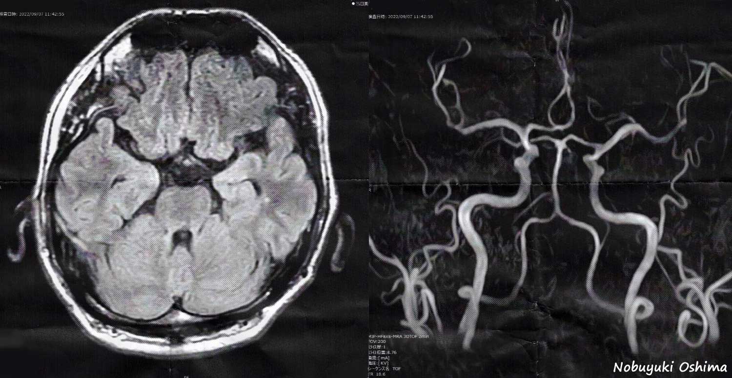 脳のMRI、MRA検査画像(2022年9月7日)