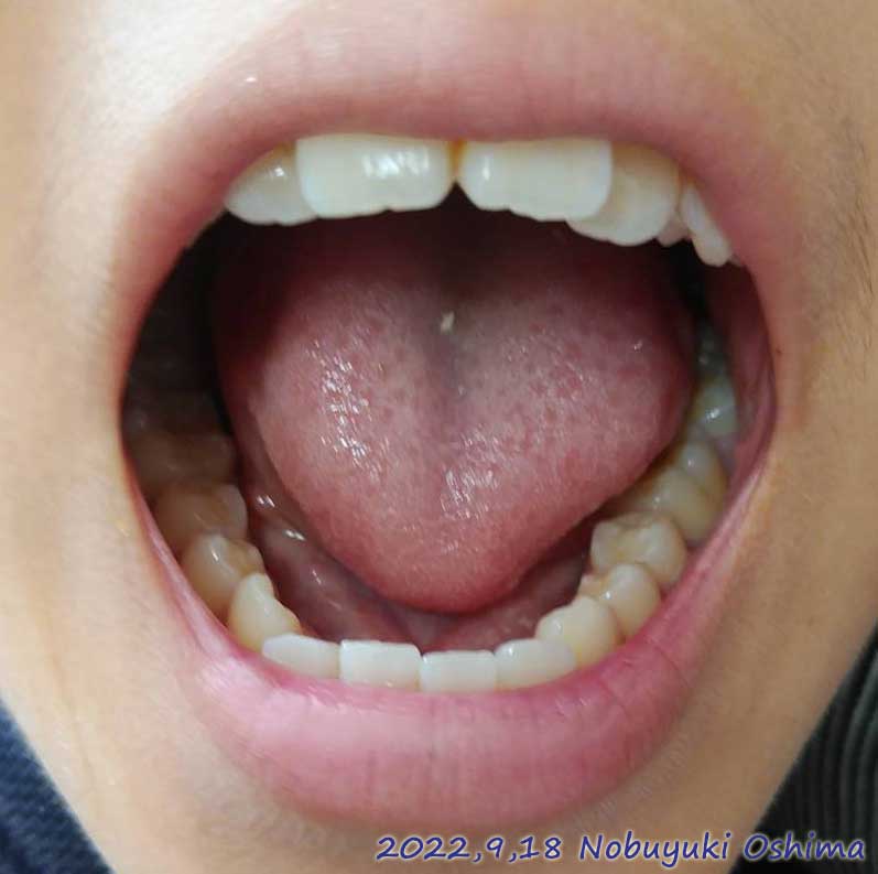 中学3年生になった長男（15歳）の歯