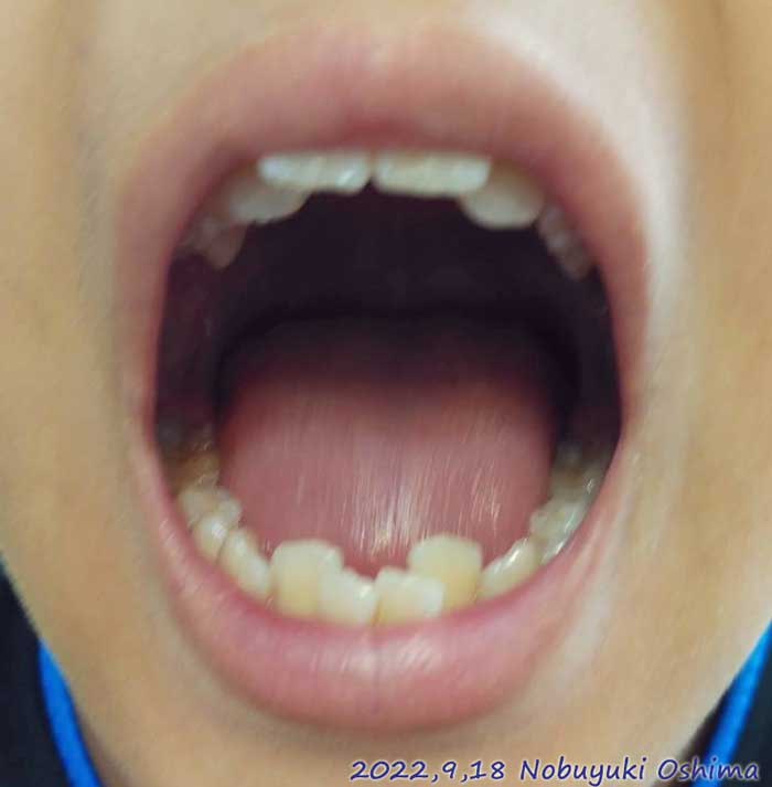 小学5年（11歳）の次男の歯